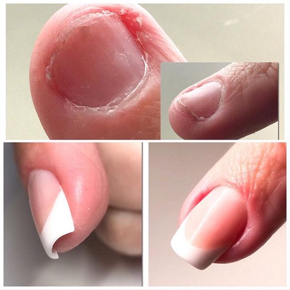 Reconstruction D'ongles Rongés